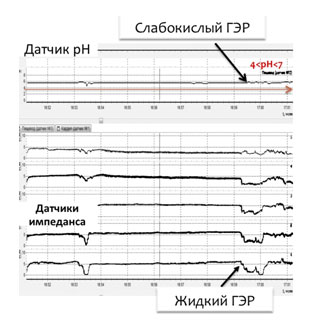Рис. 4. рН-импедансометрия пищевода: слабокислый жидкий рефлюкс