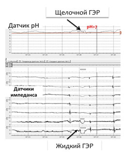 Рис. 5. рН-импедансометрия пищевода: щелочной жидкий рефлюкс