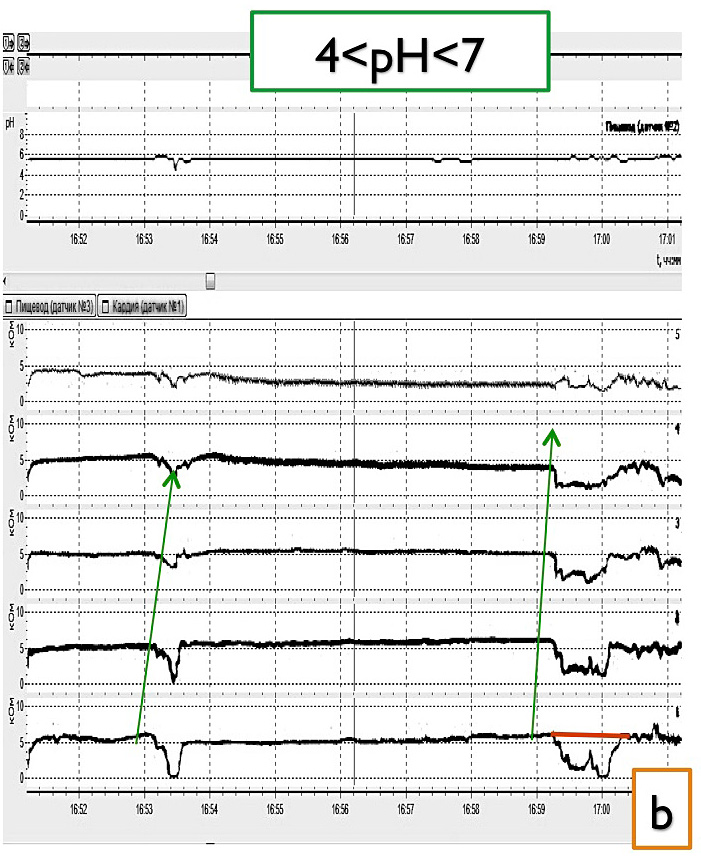 Fig. II. Combined impedance-pH recordings allows to identify the three types of reflux:b) Liquid weakly acidic reflux: retrograde drop in impedance starting distally together with a pH fall below 7 but above 4